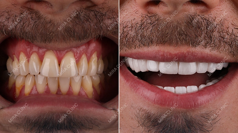 Before and After dental implants